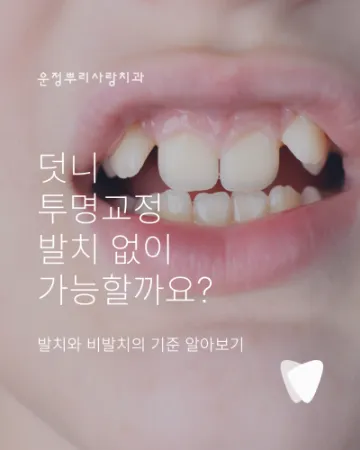 운정 덧니 투명교정, 발치 없이 가능할까요?