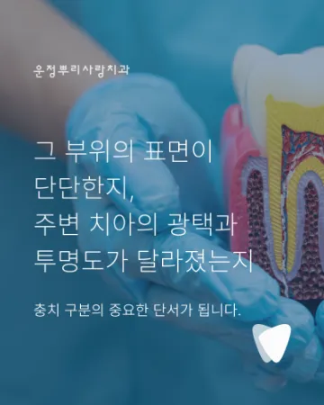 치아의 검은 점은 모두 충치일까요? 착색과 구분하는 방법