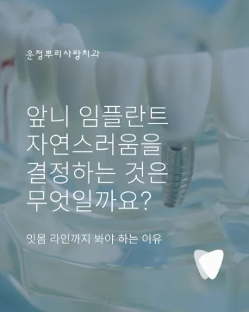 앞니 임플란트, 잇몸 라인까지 봐야 하는 이유