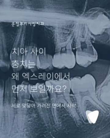 치아 사이 충치는 왜 엑스레이에서 먼저 보일까요?